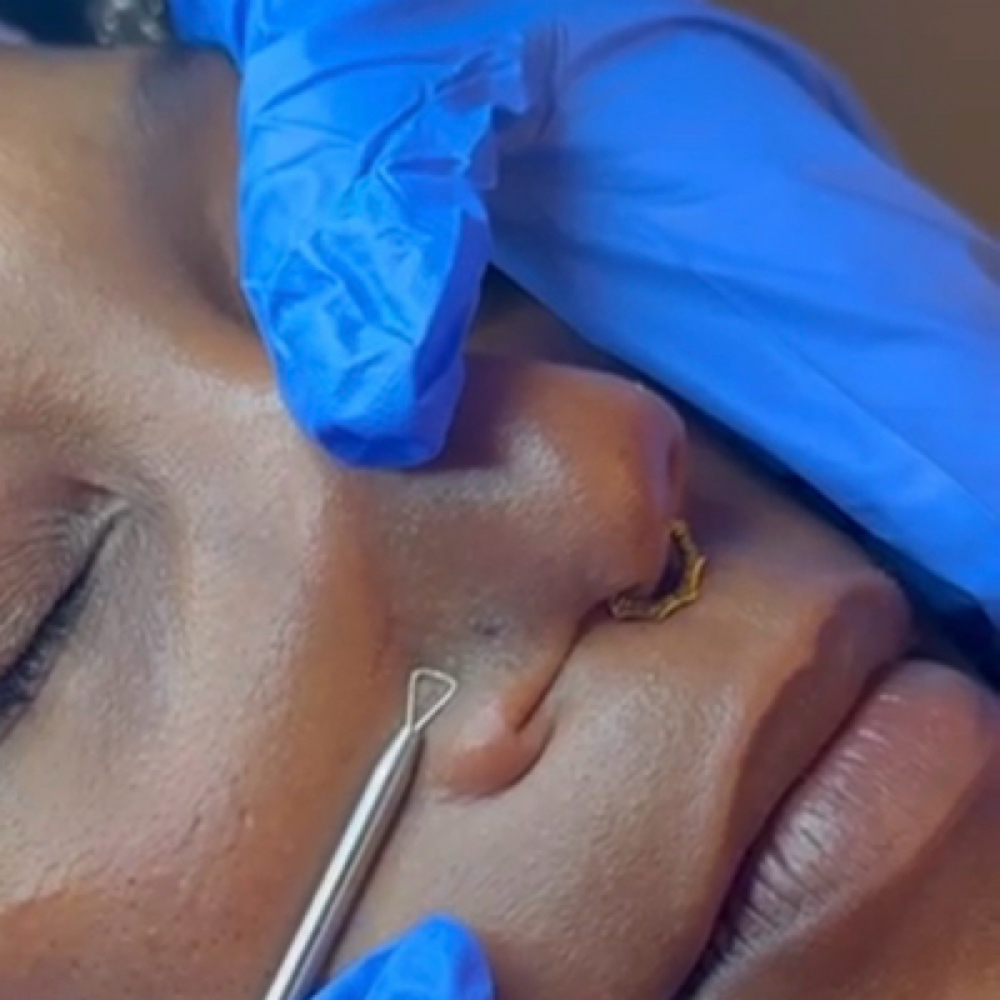 Extractions at Zen Essence Spa & Wellness in Brooklyn, NY