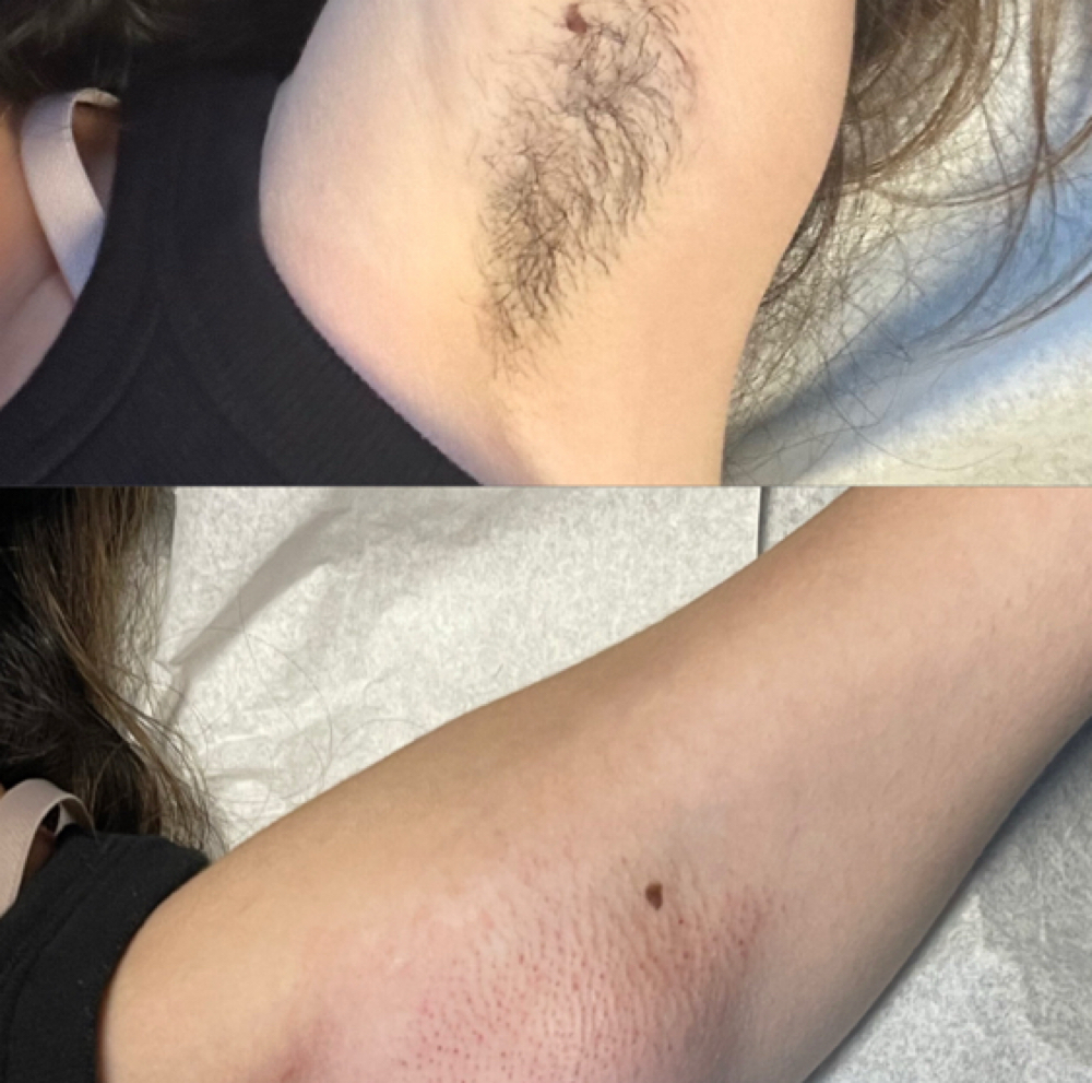 Body Wax(underarms) at dreamglowbym in Springdale, AR