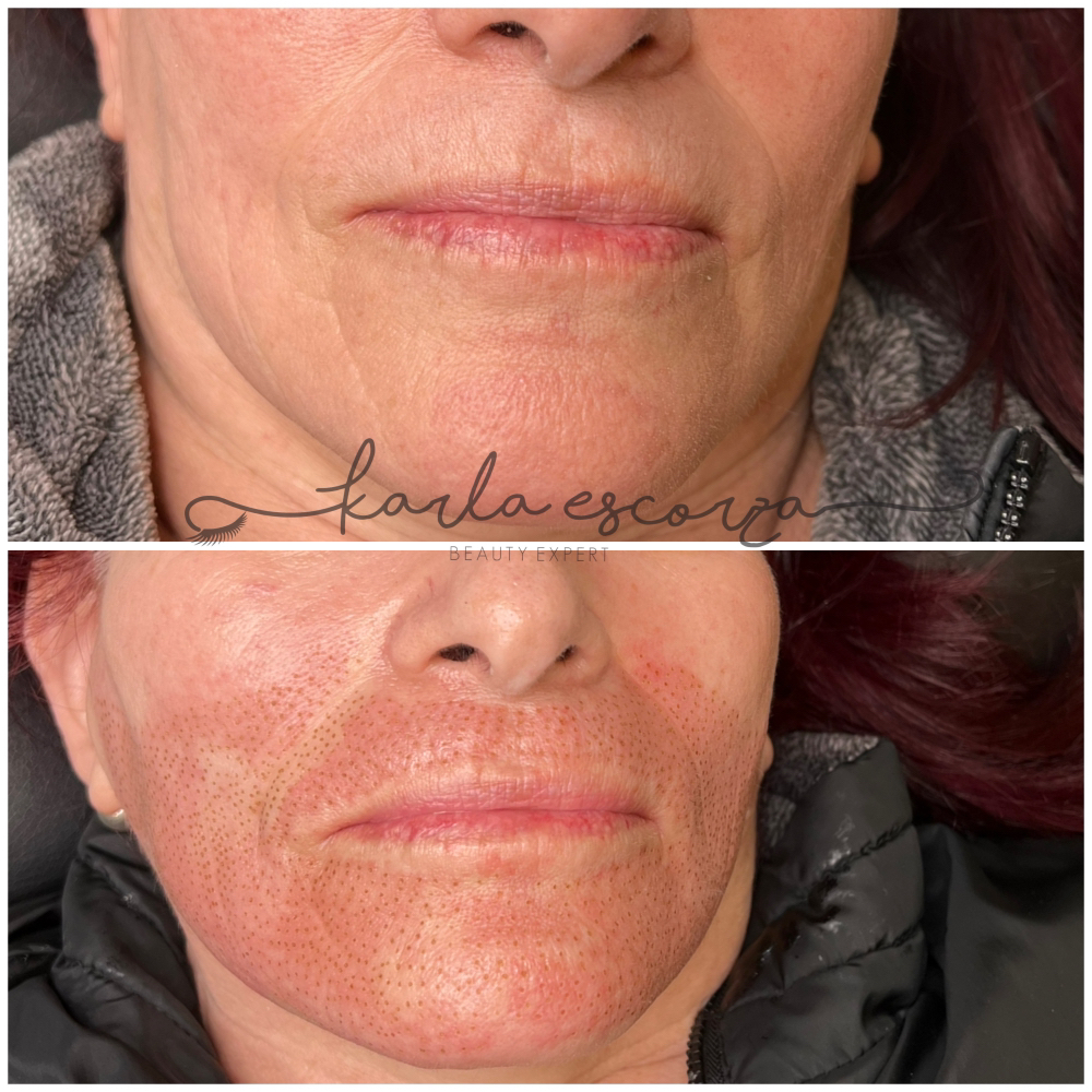 nasogenians Fibroblast at LASHES AND BROWS By Karla Escorza in Northglenn, CO