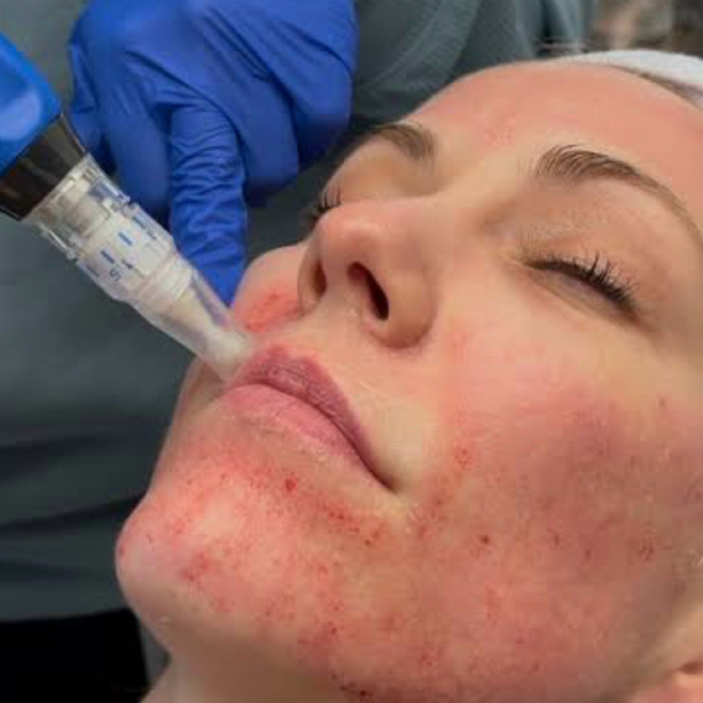 Microneedling at Ana Aesthetic & Beauty in Freeport, NY