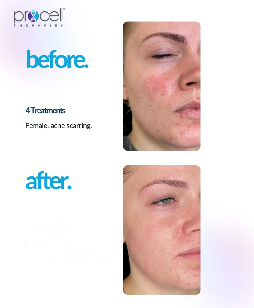 Procell Therapies Acne Scarring