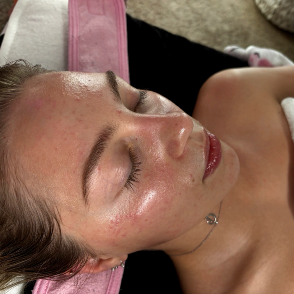 Acne peel at Perfectly Imperfect in milan, MO