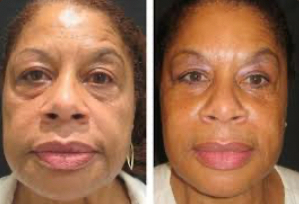 Non Surgical Face Lift