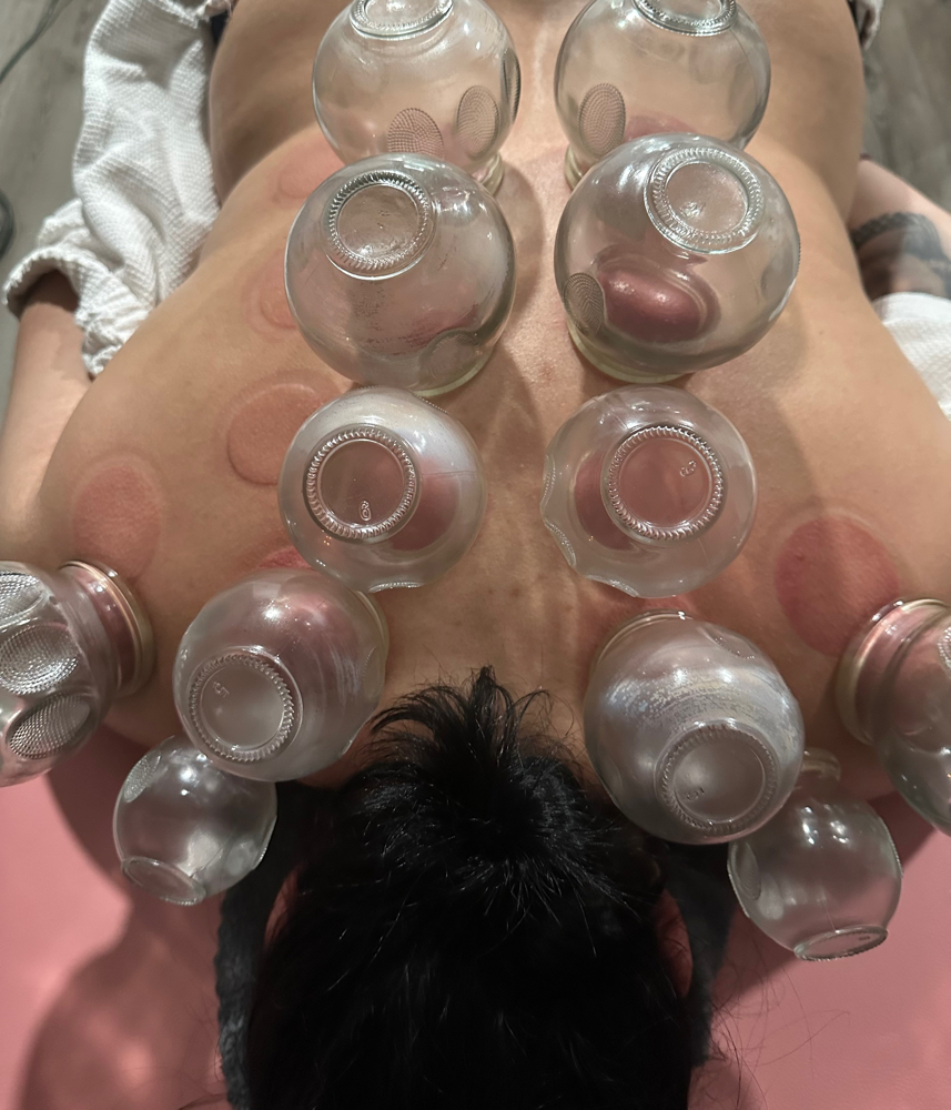 Fire Cupping Therapy