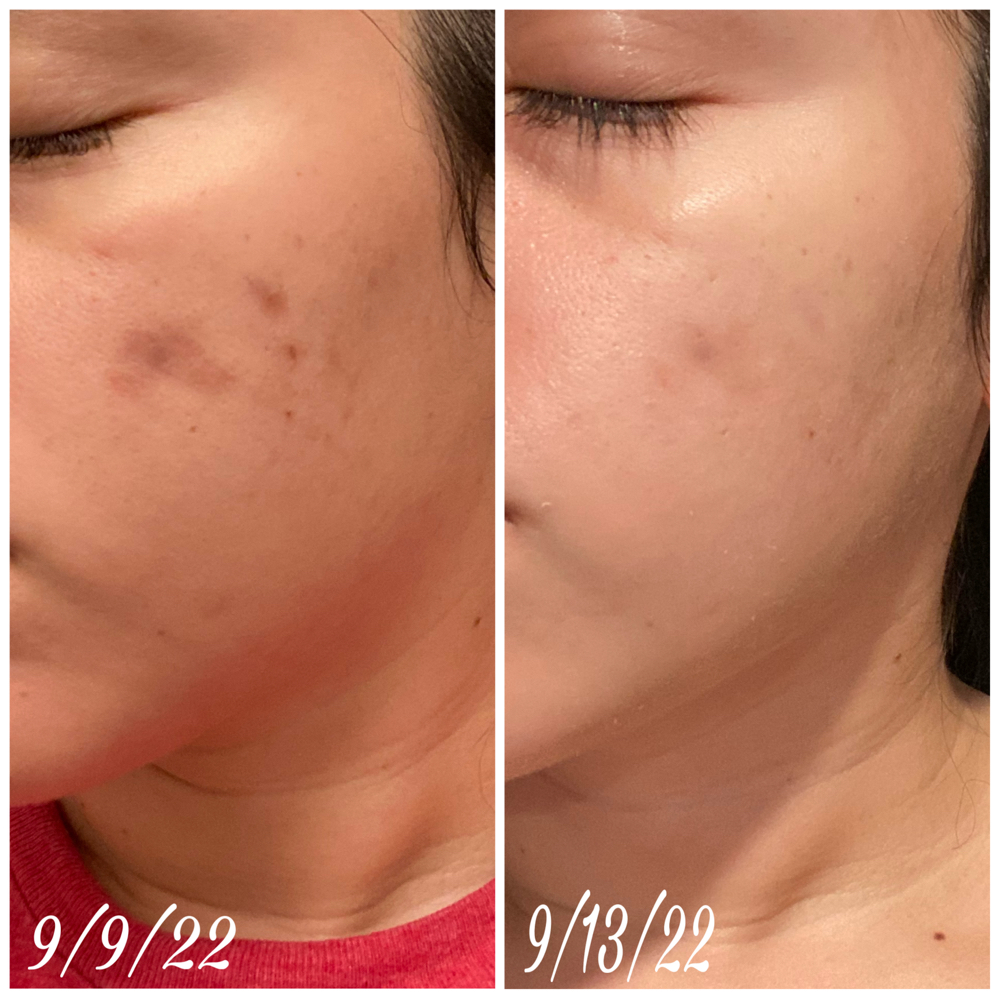 Pigment Eraser Peel