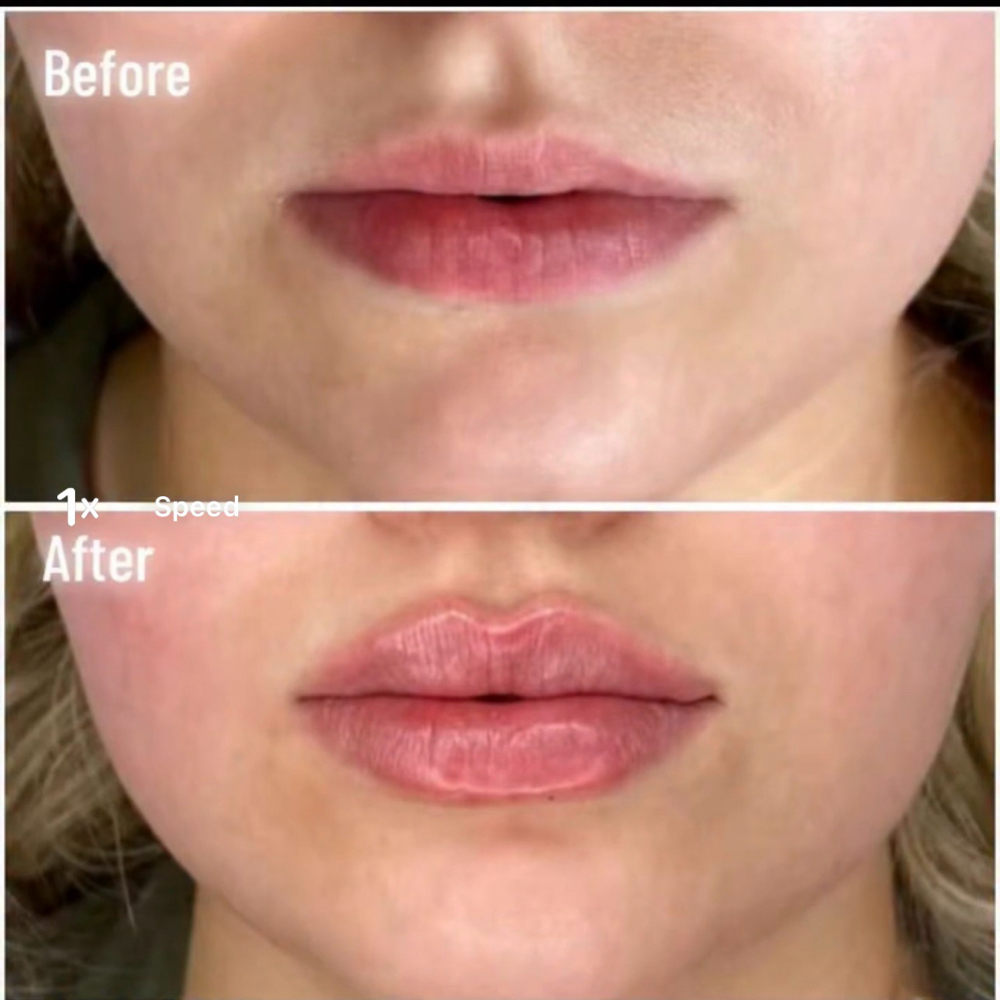 Dermal Fillers at AlyZel Aesthetics & Wellness in Lubbock, TX