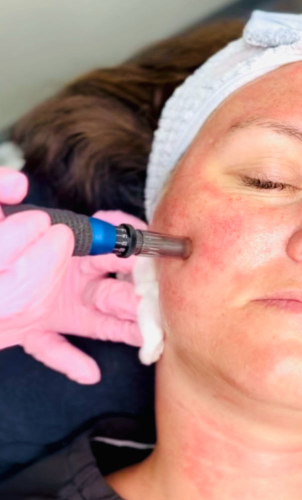 Microneedling