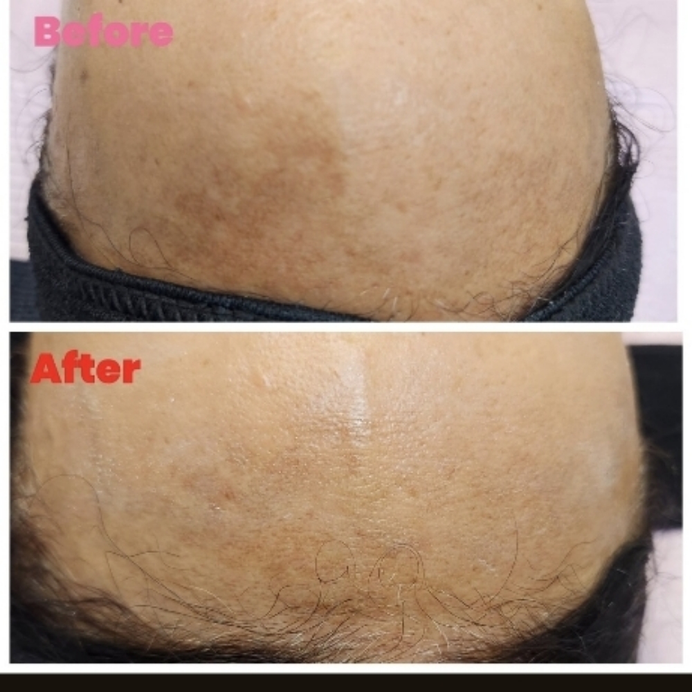 Advace Hyperpigment Chemical Peel at Sun Skincare LLC in Scottsdale, AZ