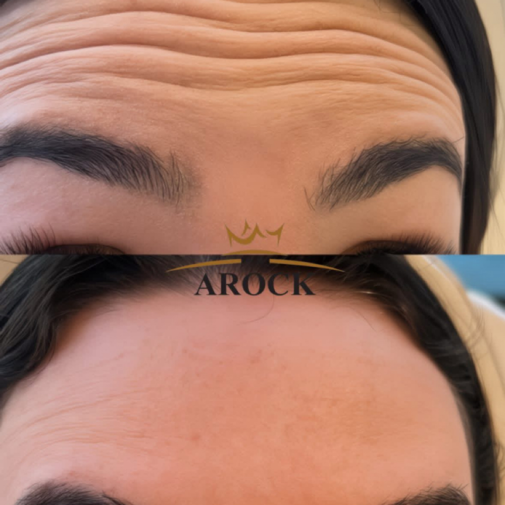 Botox at ARock Beauty & Wellness in San Angelo, TX