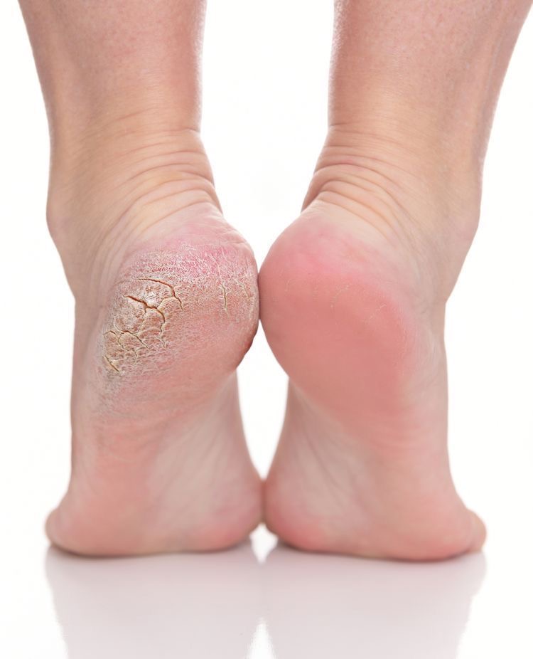 Callus Remover at Nails_by_Ethel in Monessen, PA