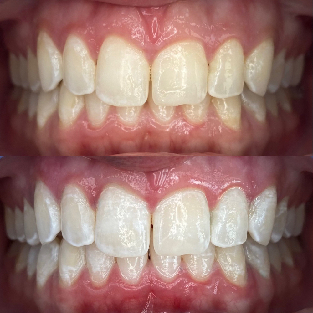 Advanced Teeth Whitening For 2