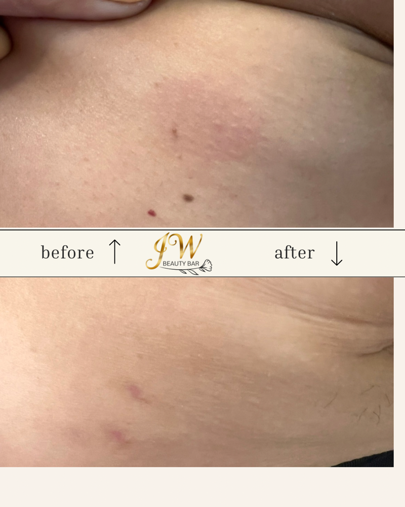 Superfrecator Treatment