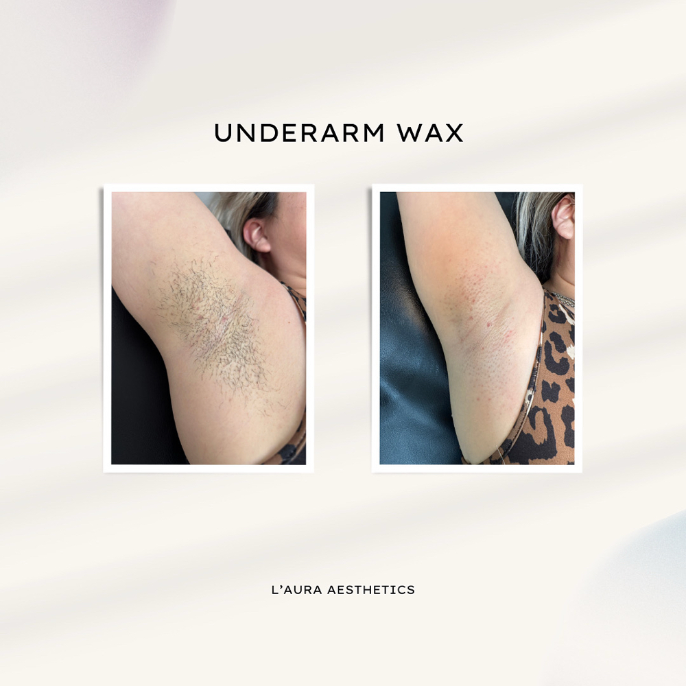 Underarm