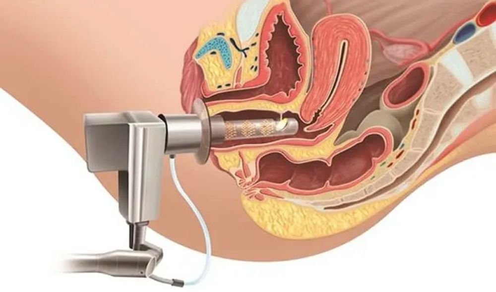 Rejuvenecimiento Vaginal at Dream Body Esthetic in Orlando, FL