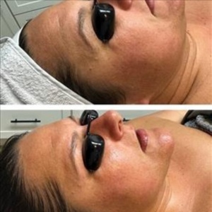 Korean glass skin peel at Marco Island Aesthetics