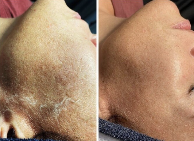 Dermaplaning