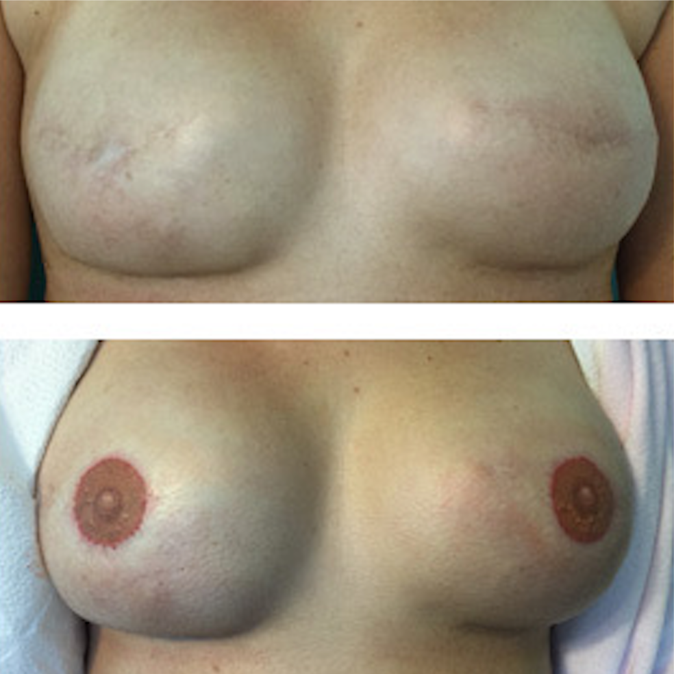 3D Nipple Tattooing at ARTISTREE in BEL AIR, MD