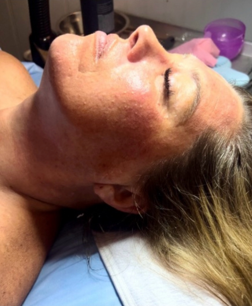 Microneedling Facial