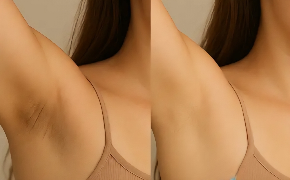 Skin Lightening- 1 Treatment