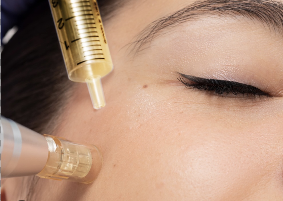 Microneedling + PRP  SkinPen®