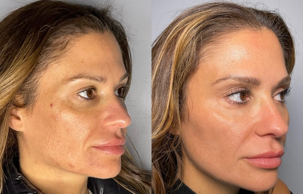 Microneedling