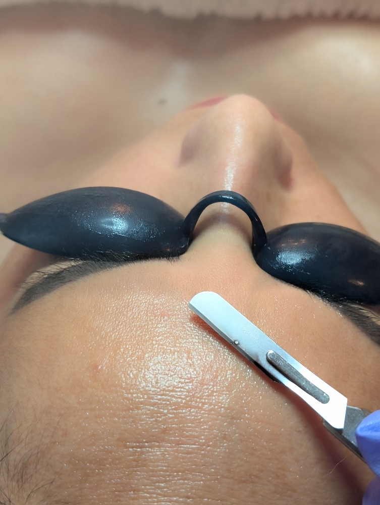 Add-On Dermaplaning