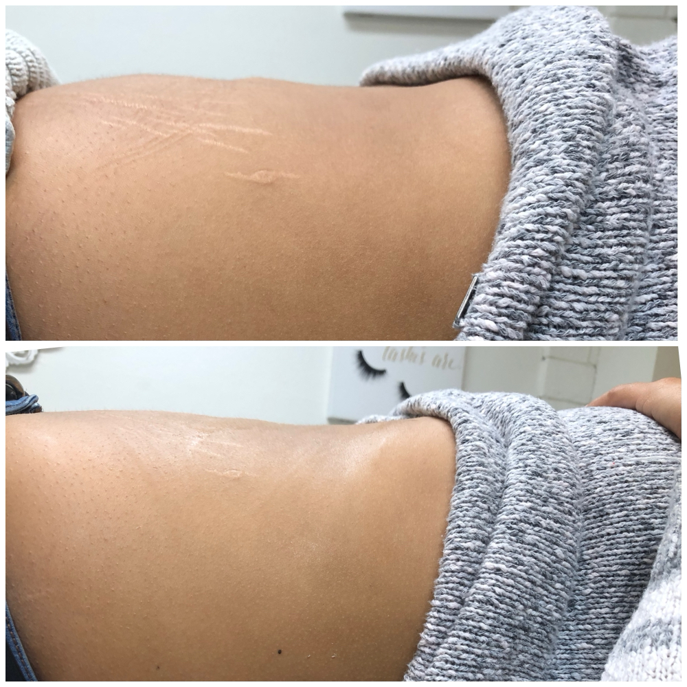 Cavitation Lipo at Babe And Bloom in Prescott, AZ