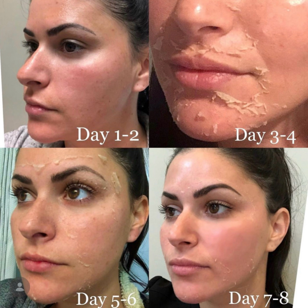 VI Chemical Peel at Spatium Urgent Care & Wellness in Marietta, GA