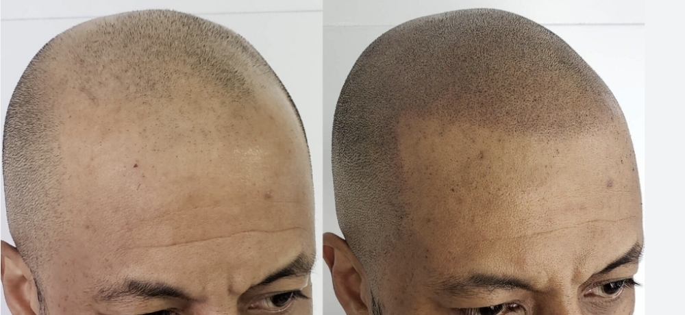 Scalp Micropigmentation FULL Head