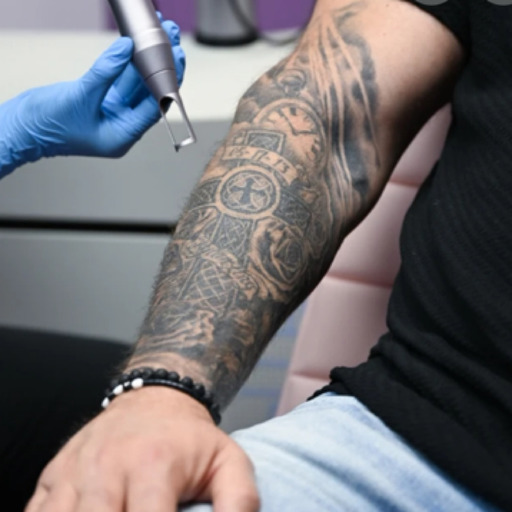 XLarge AREA (12x12”) TATTOO REMOVAL at BEAUTY LAB COLLECTIVE in Miami, FL