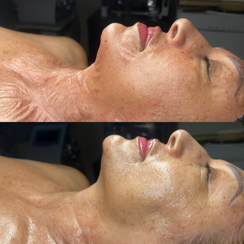 Timeless Renewal V-Tox Facial