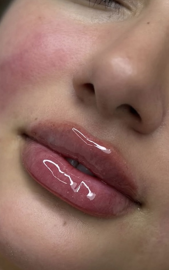 1 Syringe(ML) Lip Filler at Perfection Injections in Euless, TX