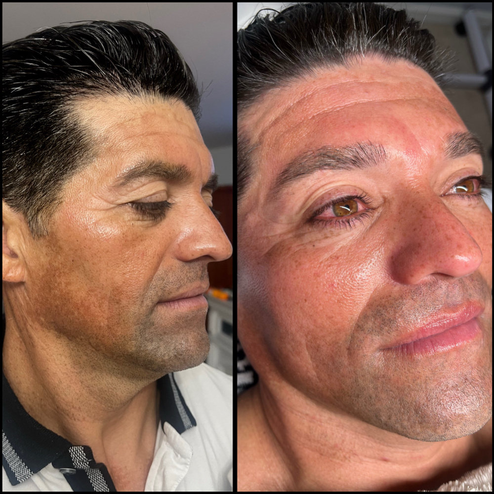 CHEMICAL PEEL FACIAL at Kai_Esthetics in Brookfield, CT