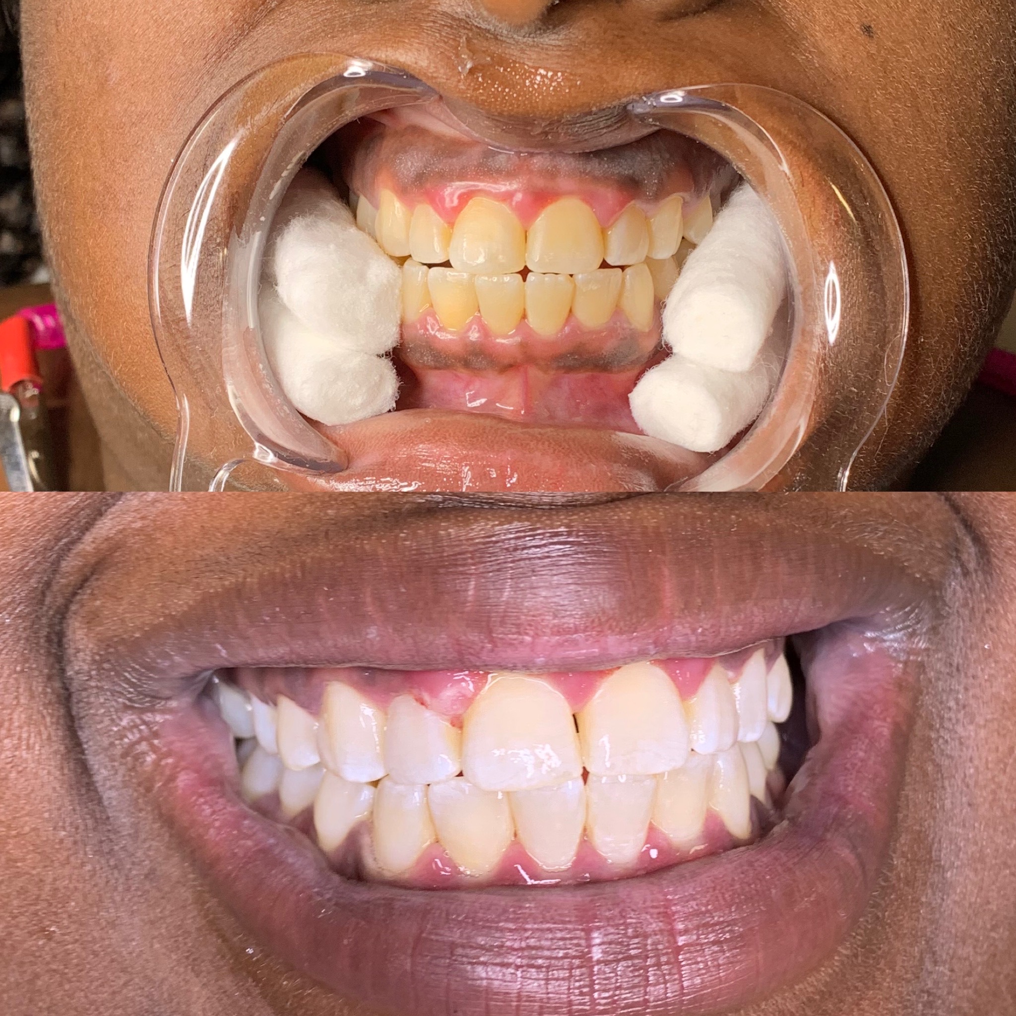 90 Minute Teeth Whitening Session