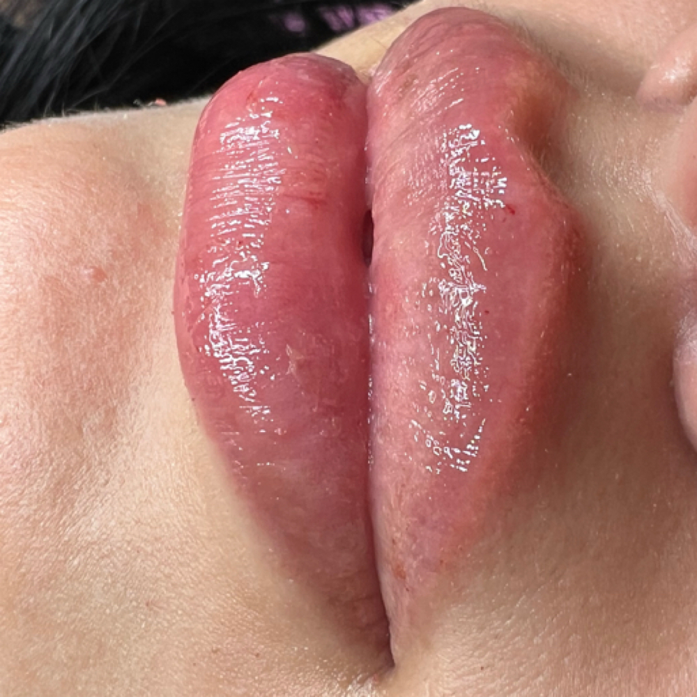Needle Free Lip Filler at Beyond Beauty Studio in Rowlett, TX