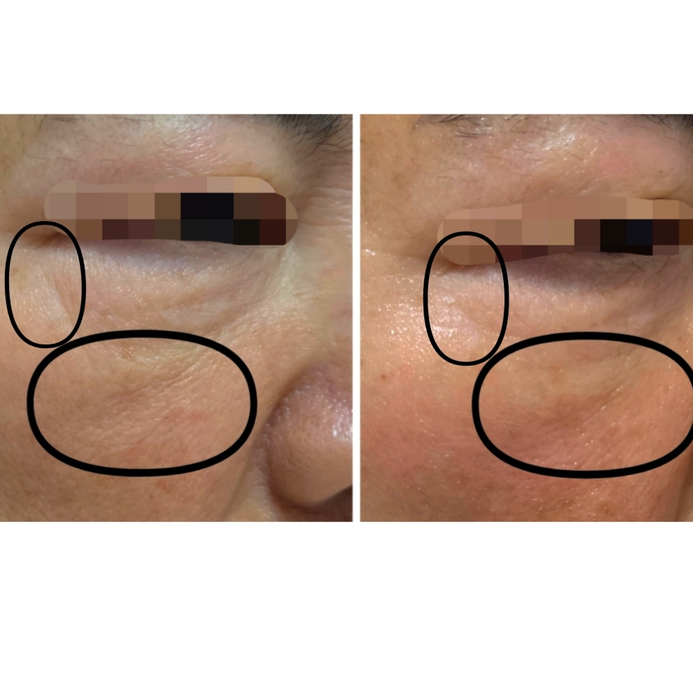 HiFu For Forehead And Under Eye