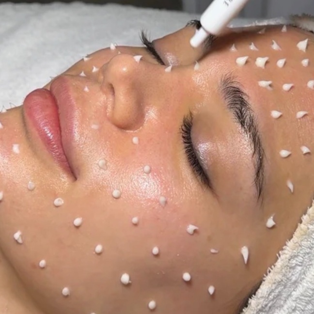 Liquid Microneedling at Golden Aura Skin in Fort Myers, FL