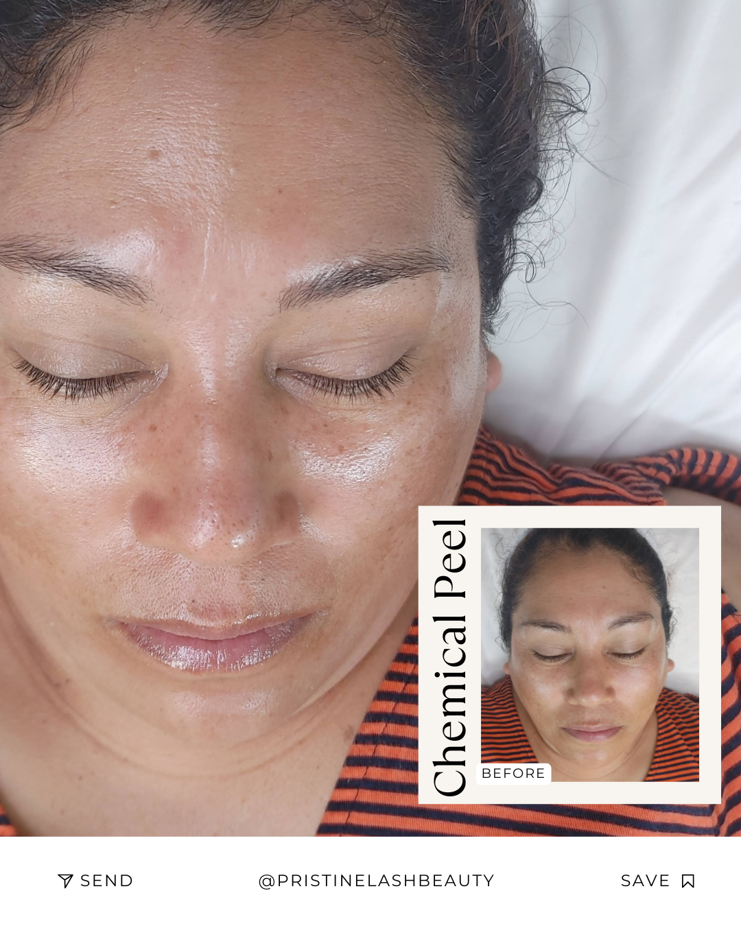 Chemical Peel Facial