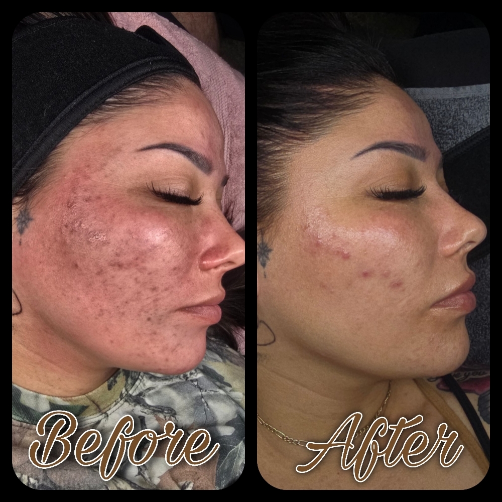 Chemical Peels at Stae Awhile X LA Perez in Pueblo, CO