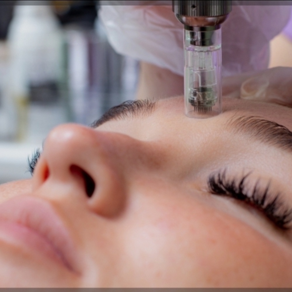 Microneedling at Desert Glow Esthetics in EL Paso, TX
