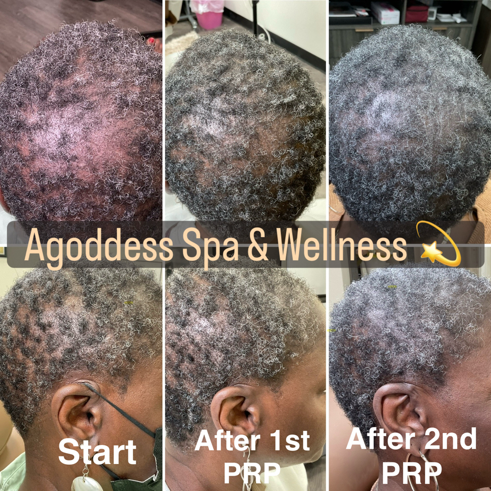 PRP/PRF Face or Hair Restoration at Agoddess Spa & Wellness in DeSoto, TX