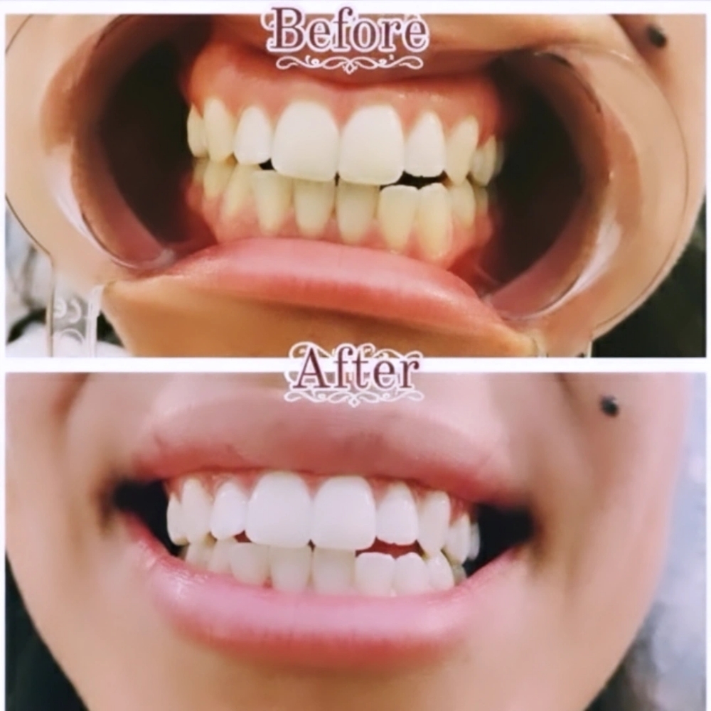 Teeth Whitening at Luxury Lashes & Skincare in Tulare, CA