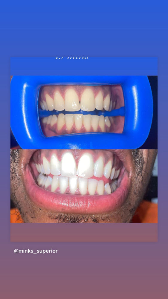Cosmetic Teeth Whitening 45Minutes