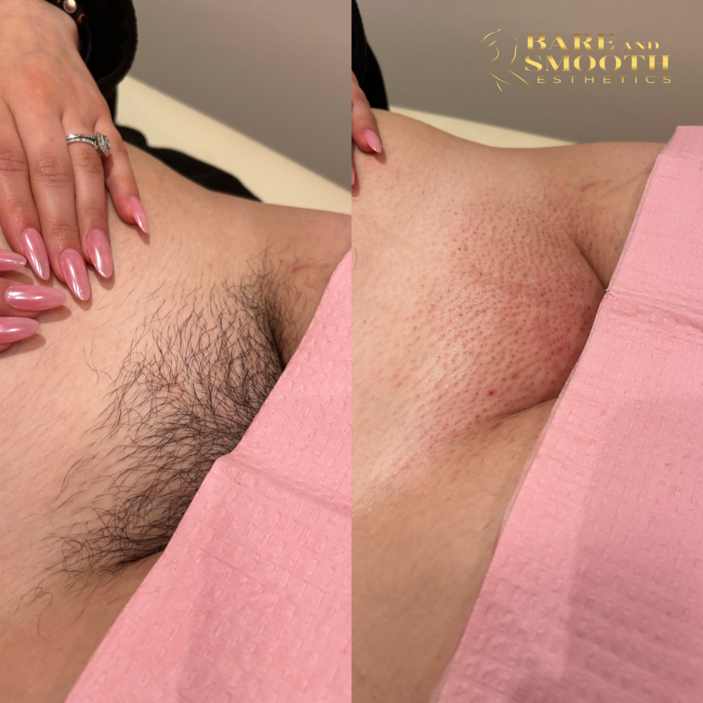 New Client Brazilian at BARE AND SMOOTH ESTHETICS LLC in Lombard, IL