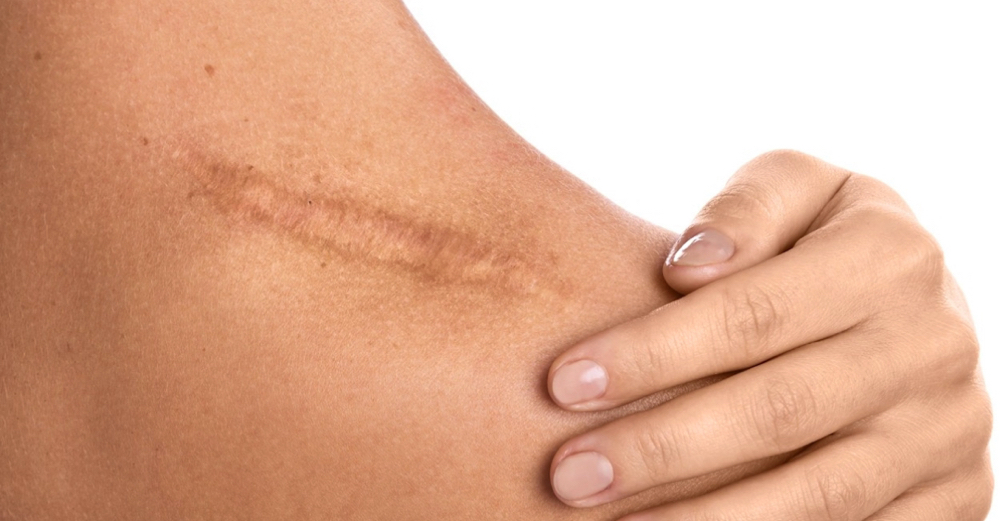 Scars