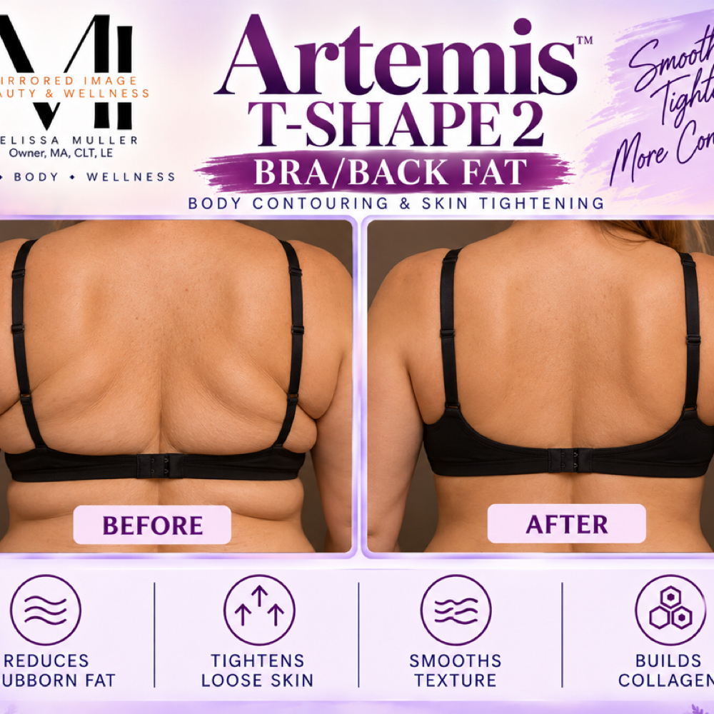 Artemis T- Shape 2 - Bra Fat / Back Fat at Mirrored Image Beauty & Wellness in Oconomowoc, WI