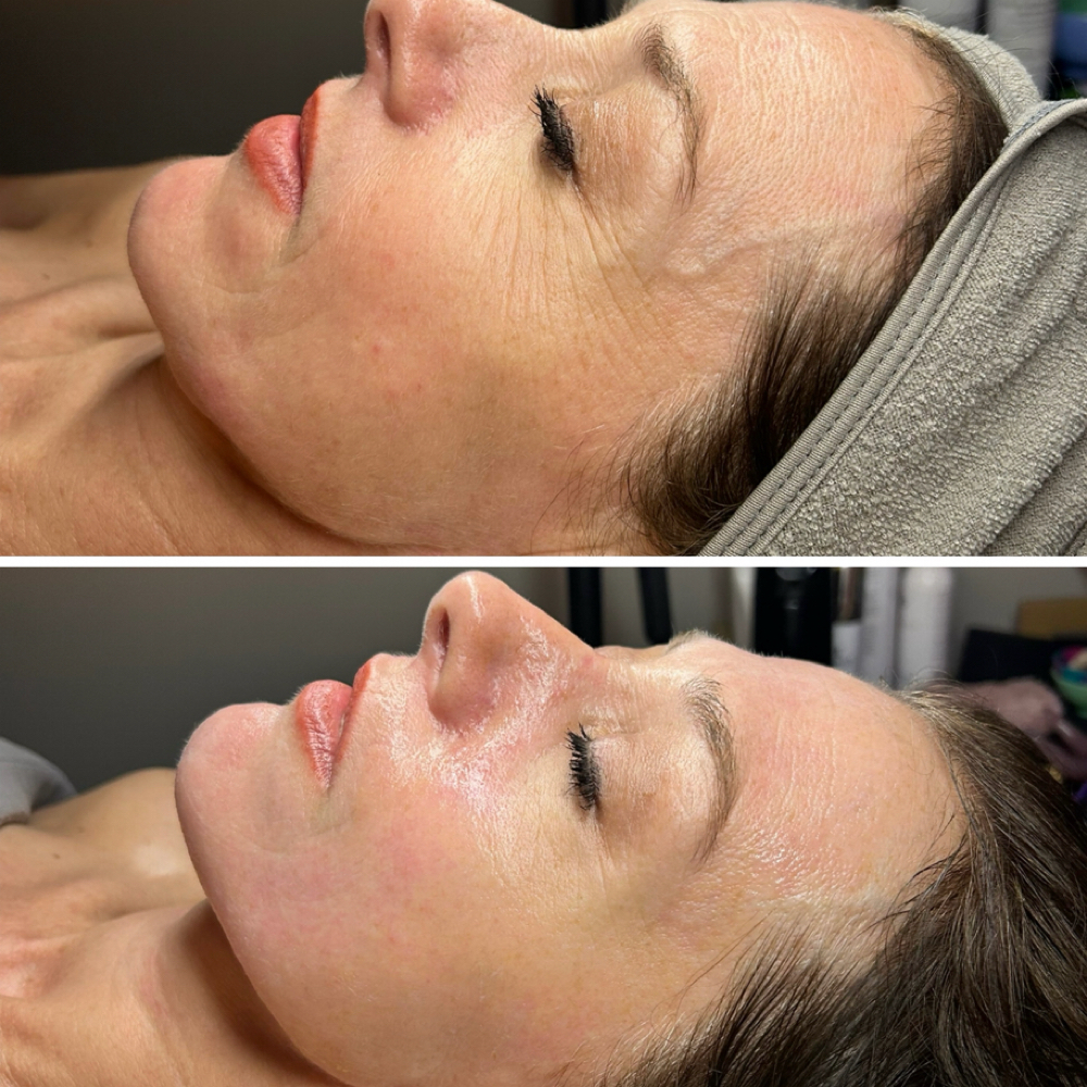 Beyond Botox at Haylee Jade Esthetics LLC in Ellijay, GA