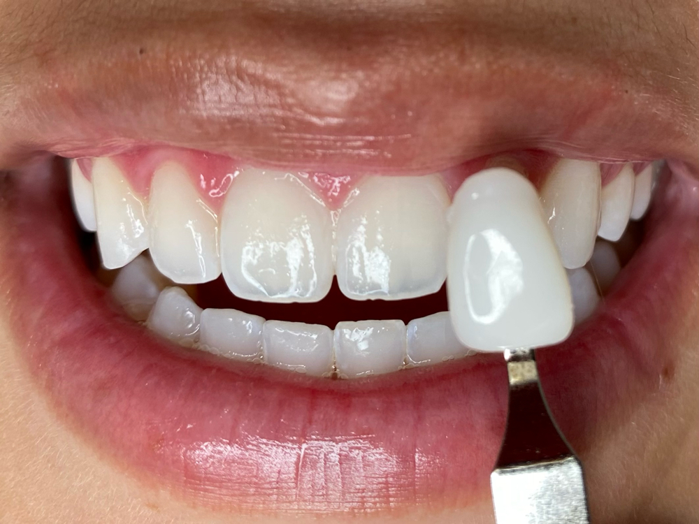 Blue Light Teeth Whitening 60 Min