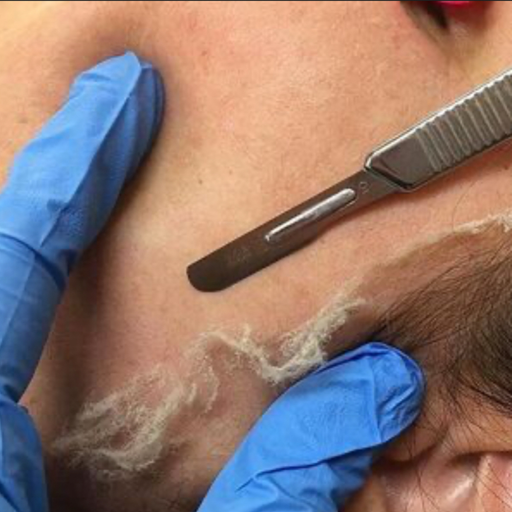 Dermaplane Facial 90Mins/60Mins at Revive Esthetics in Avondale, AZ