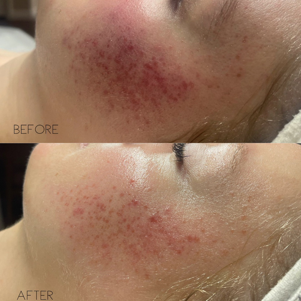 ROSACEA FACIAL